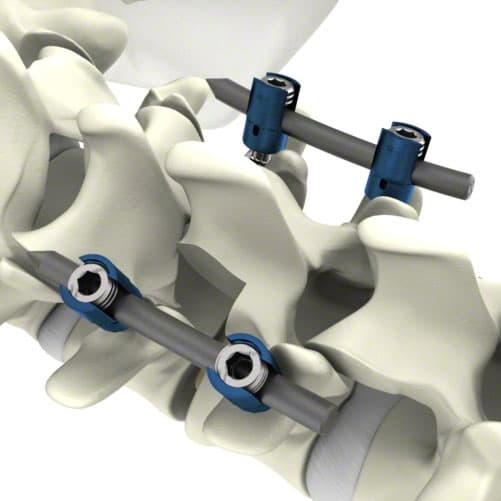 S4® Spinal System-Produktbild Vergrößerung CW