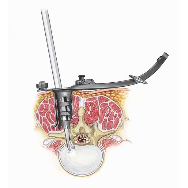 Spine Classics MLD System-Produktbild Vergrößerung CW