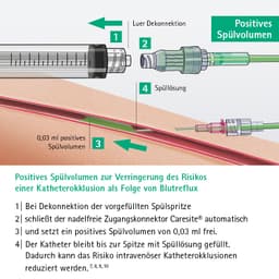 Caresite Positives Spülvolumen-Positives Spülvolumen zur Verringerung des Risikos einer Katheterokklusion als Folge von Blutreflux