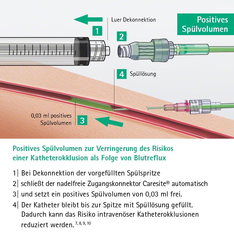 Caresite Positives Spülvolumen-Positives Spülvolumen zur Verringerung des Risikos einer Katheterokklusion als Folge von Blutreflux